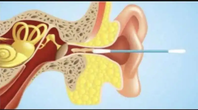 bastoncini cotonati e cerume 
