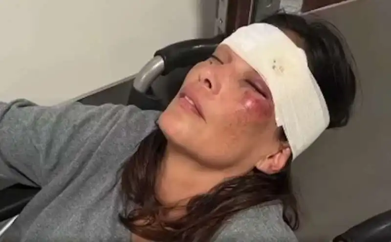 fernanda lessa con il volto tumefatto dopo l incidente   1