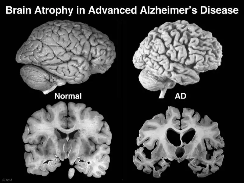 alzheimer