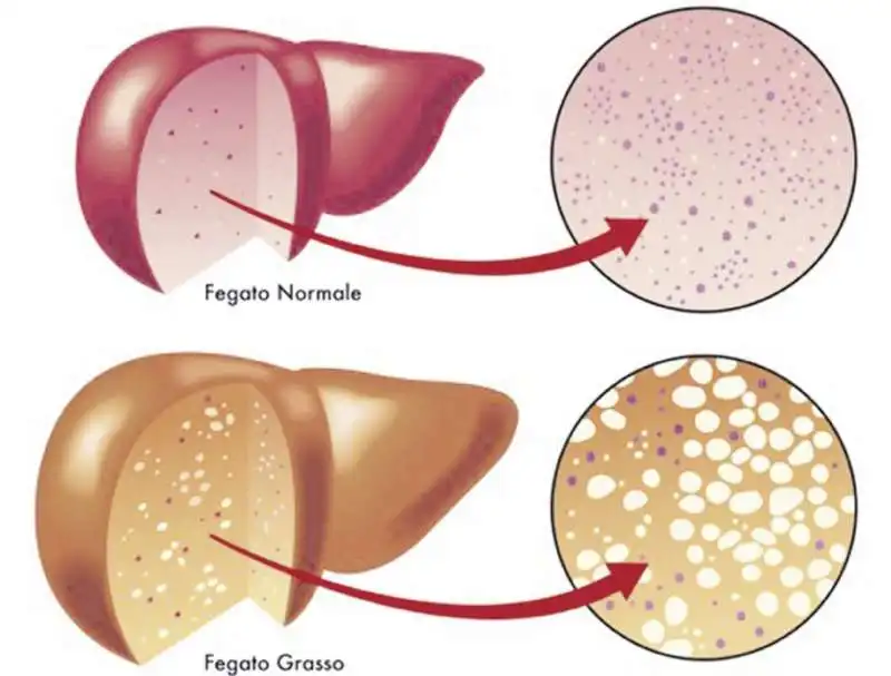 fegato grasso   steatosi epatica 7