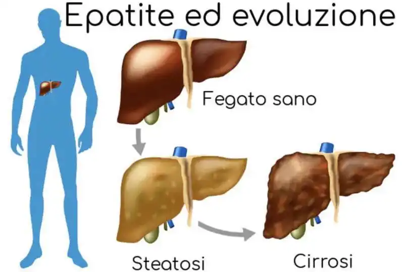 epatite 4