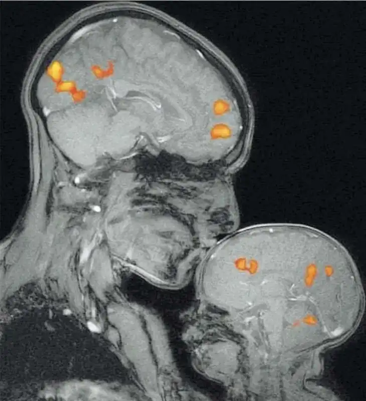 la risonanza magnetica che mostra il cervello di un bambino mentre la mamma lo bacia   pubblicata da neurology