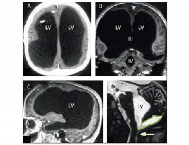 l'uomo senza cervello 2