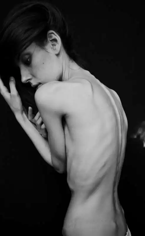 anoressia 8