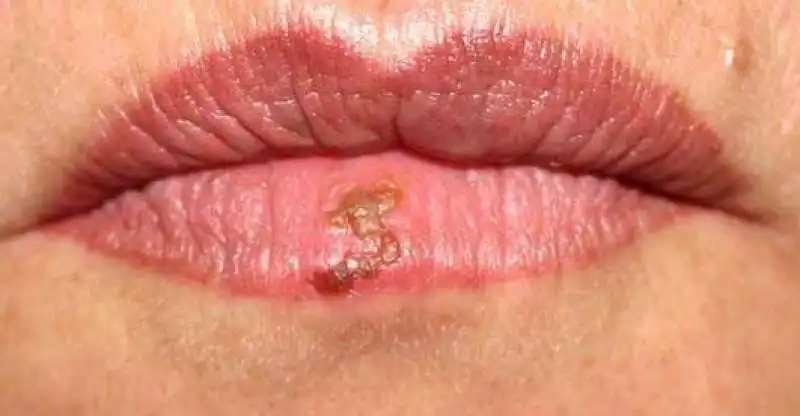 herpes 2