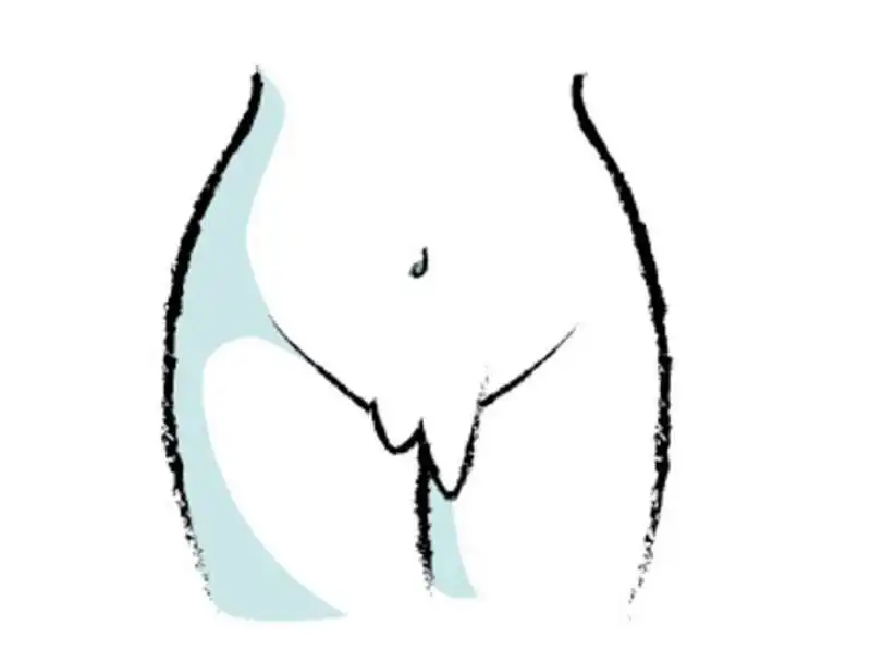 vagina con labbra asimmetriche