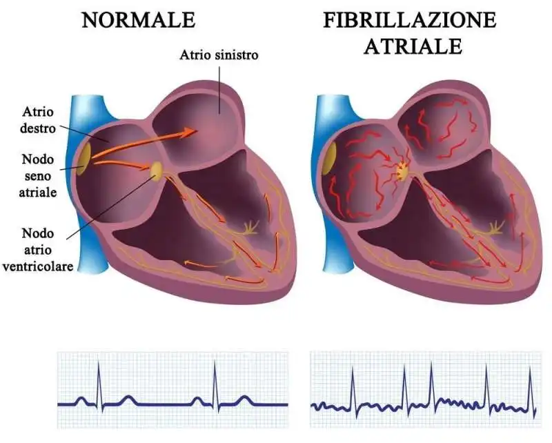 fibrillazione atriale