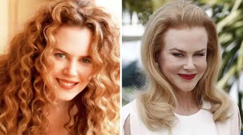 nicole kidman e il botox