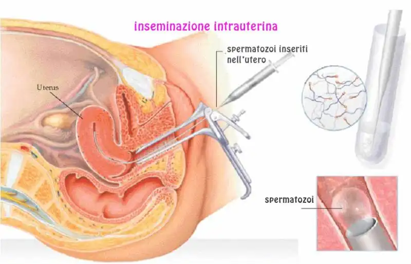 inseminazione intrauterina