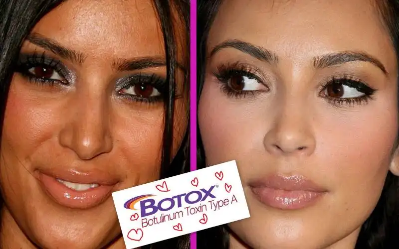 kim kardashian botox before after