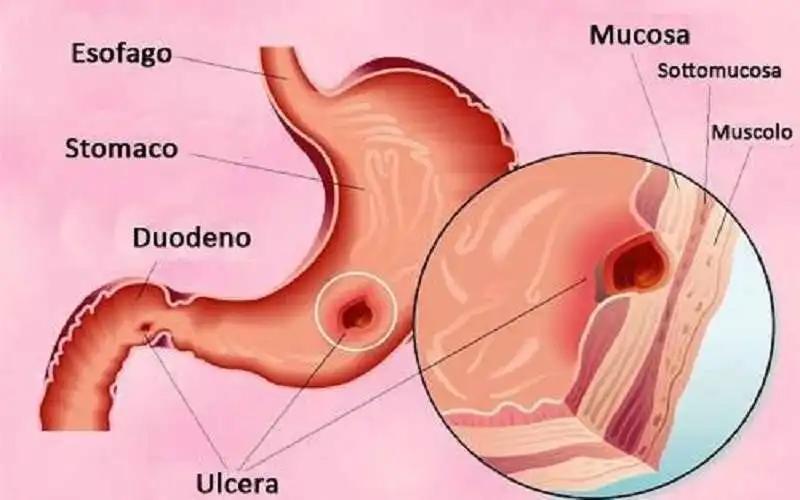 ulcera-peptica-3