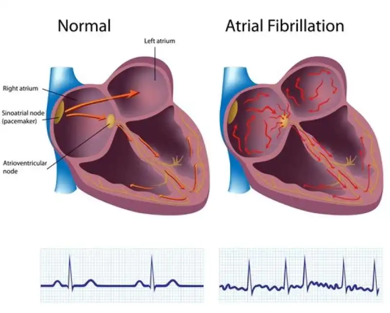 fibrillazione atriale