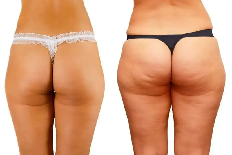 cellulite 3