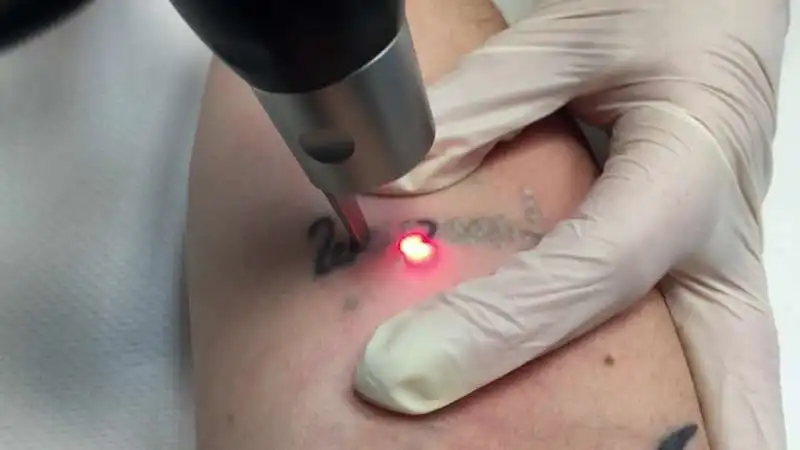 rimozione laser tatuaggi 4