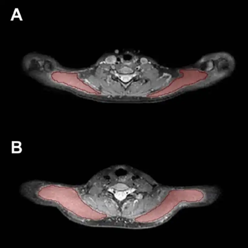 INFIAMMAZIONE AI MUSCOLI DEL COLLO  