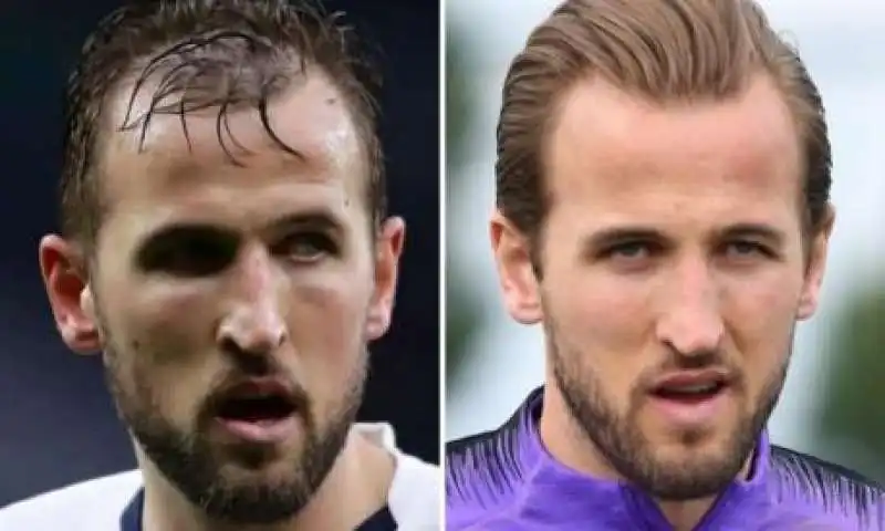 harry kane trapianto di capelli