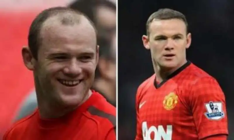 wayne rooney trapianto di capelli