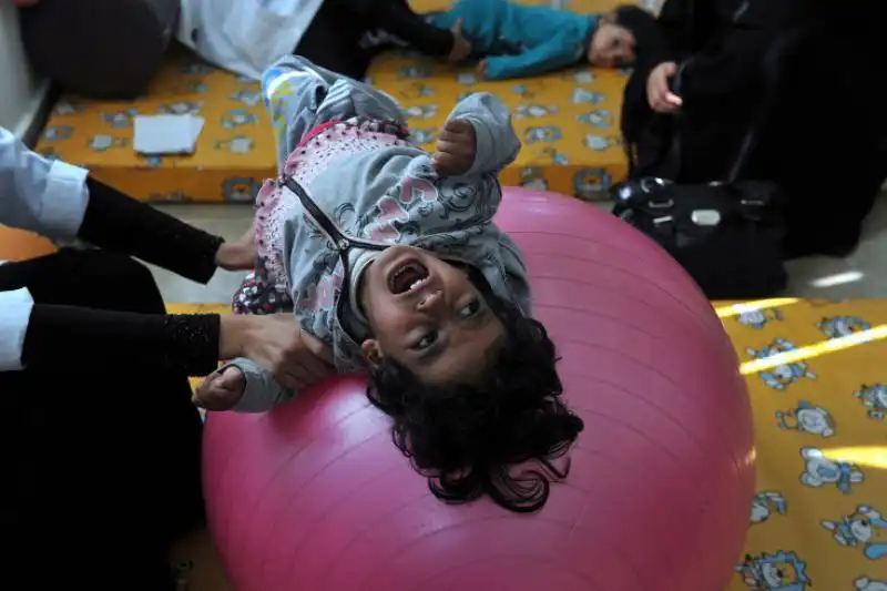 BAMBINA DISABILE FA FISIOTERAPIA A SANAA NELLO YEMEN 