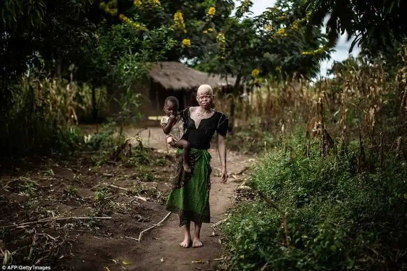 mainasi issa una donna albinia in malawi