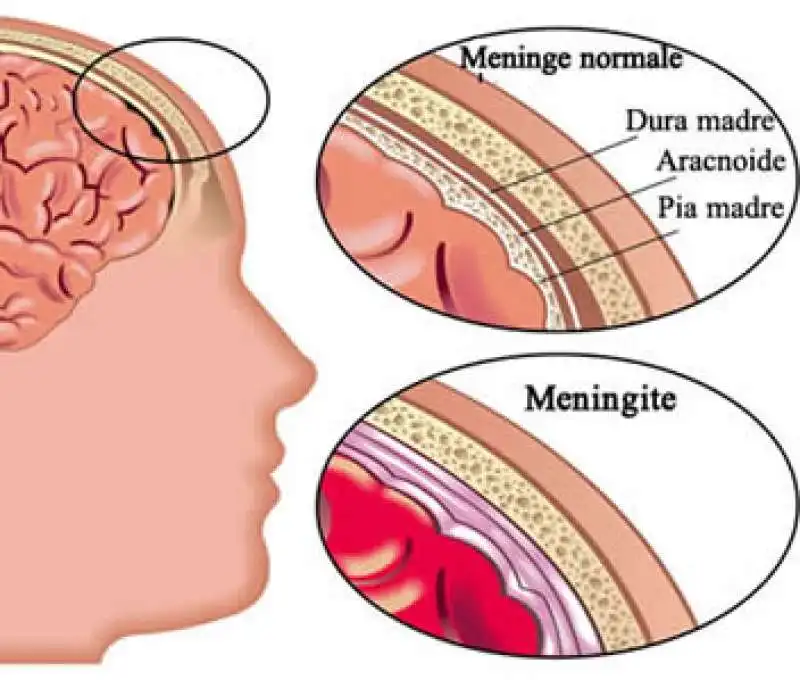 MENINGITE