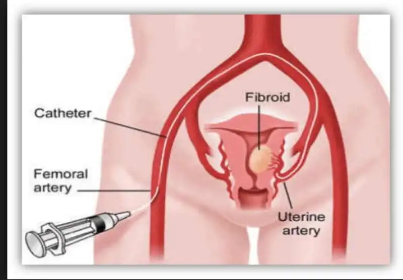 fibroma uterino 11