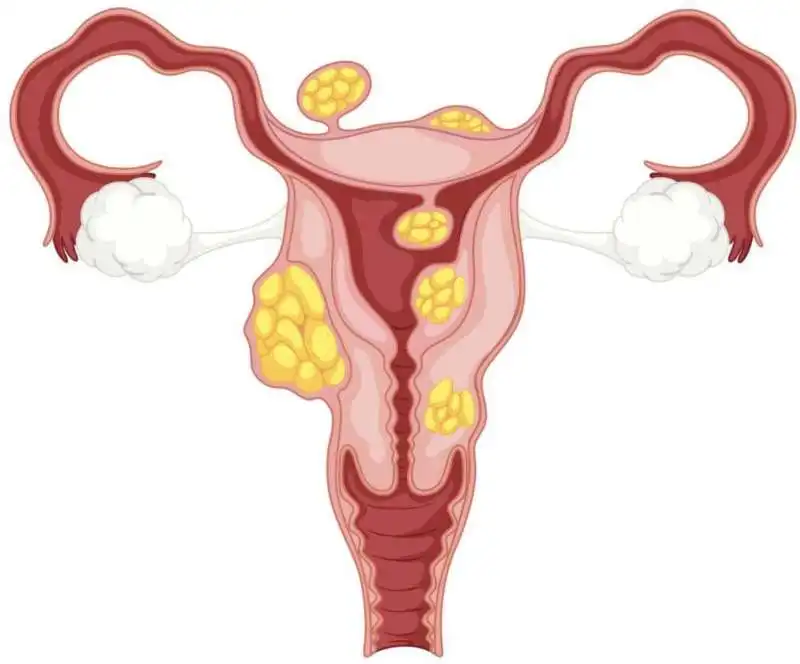 fibroma uterino 8