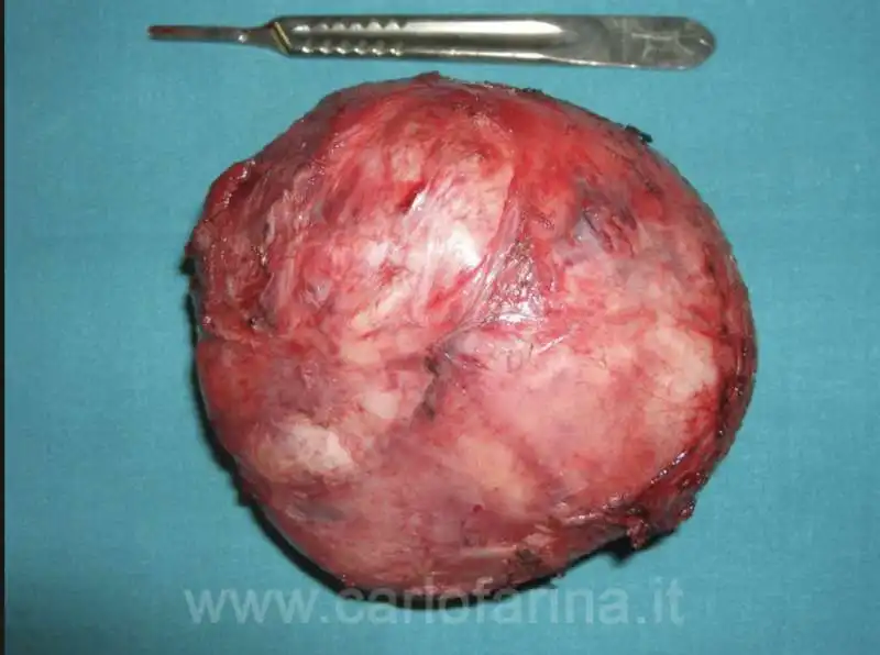 fibroma uterino 9