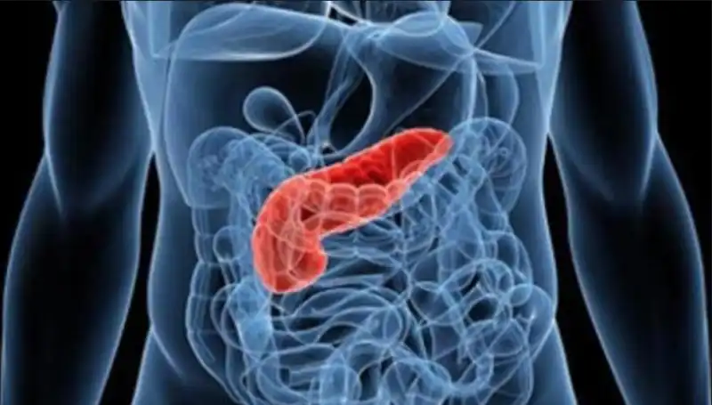 tumore pancreas