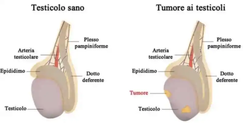 tumore testicolo 3