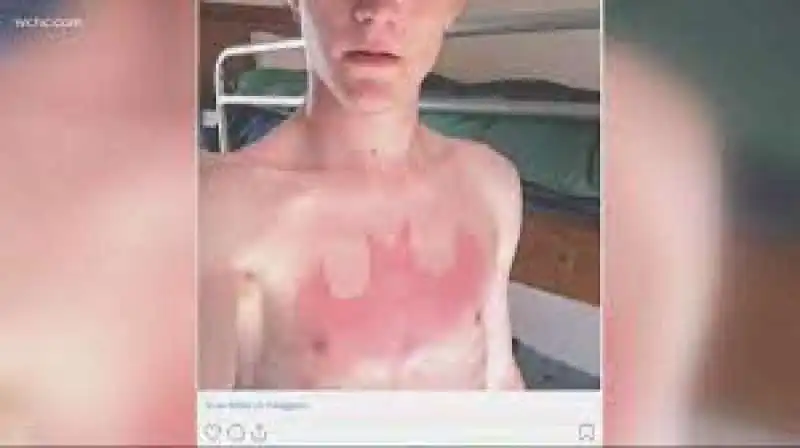 SUNBURN CHALLENGE 