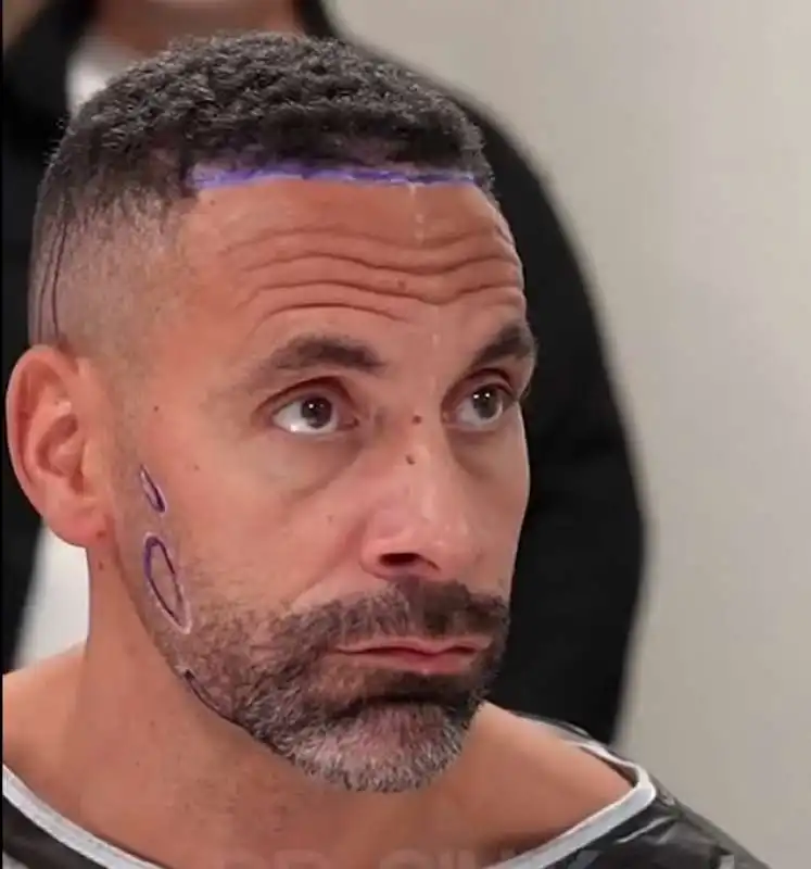 rio ferdinand trapianto di capelli 