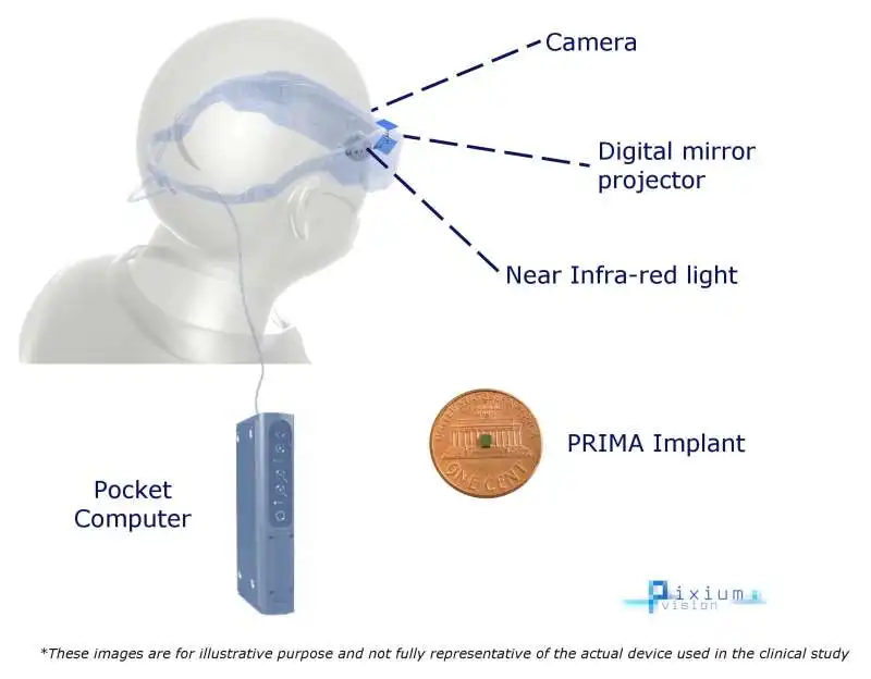 RETINA ARTIFICIALE PRIMA  