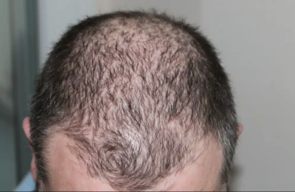 alopecia