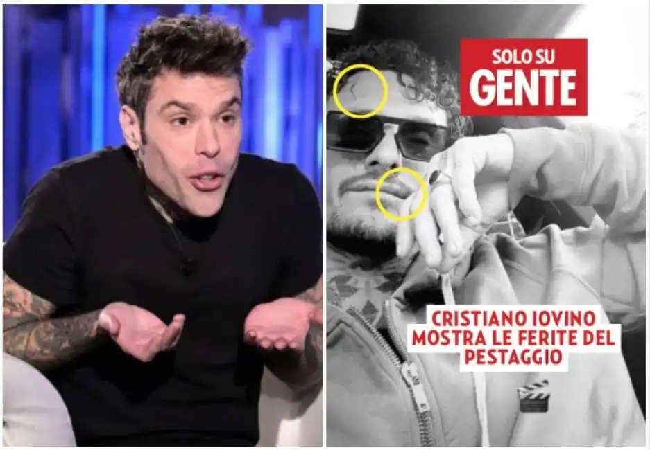 fedez cristiano iovino e le ferite del pestaggio su gente