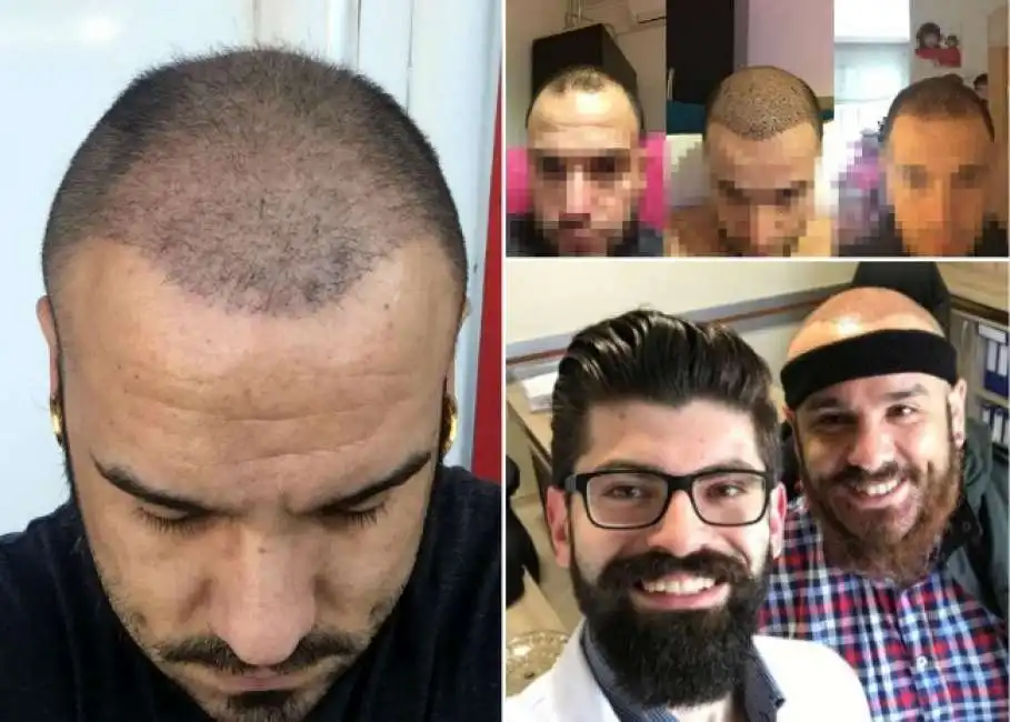 trapianto di capelli in turchia 