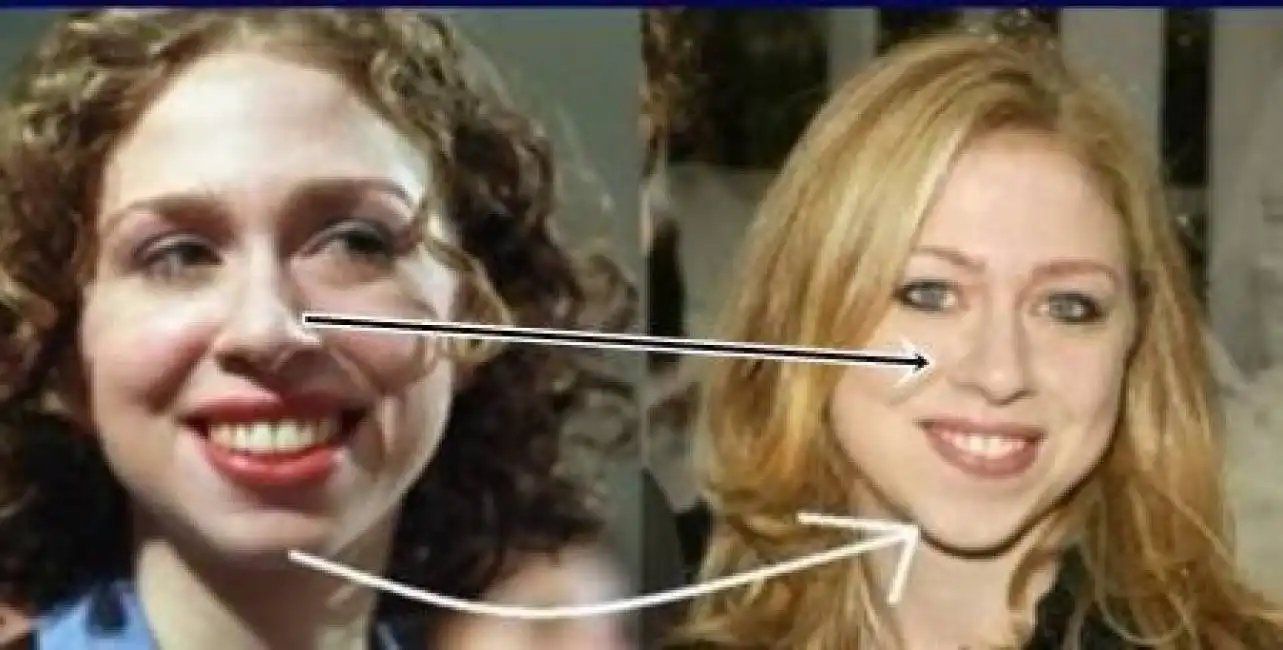 chelsea clinton nose job and cheek implants