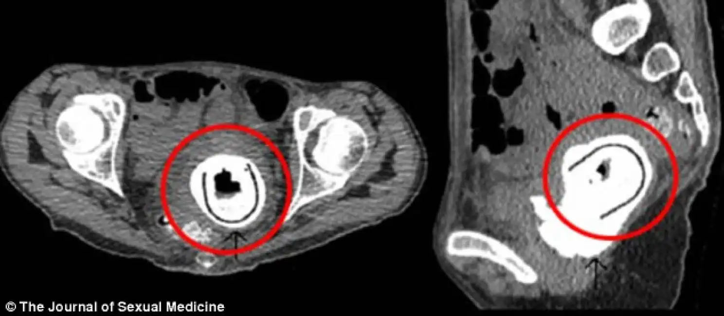 sex toy tenuto nella vagina per dieci anni