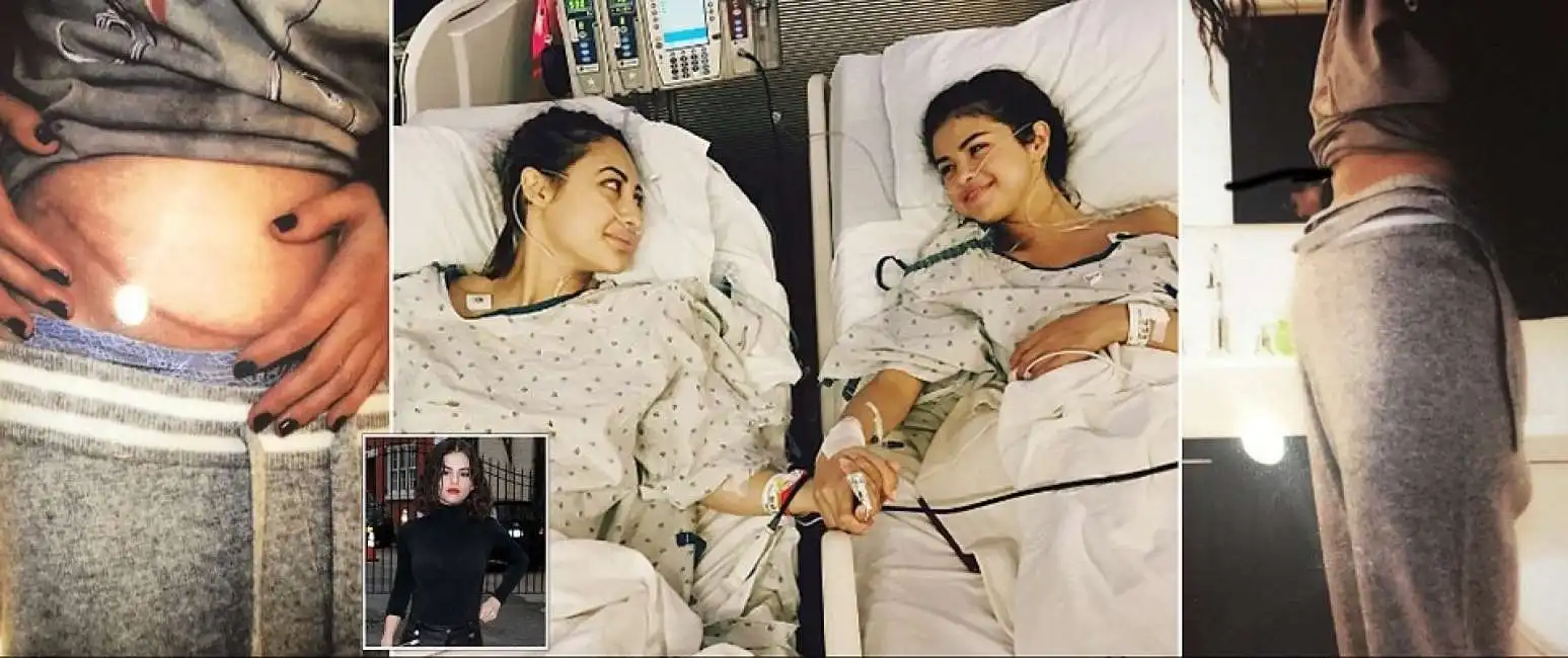 selena gomez trapianto di rene