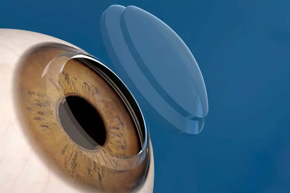 cornea artificiale